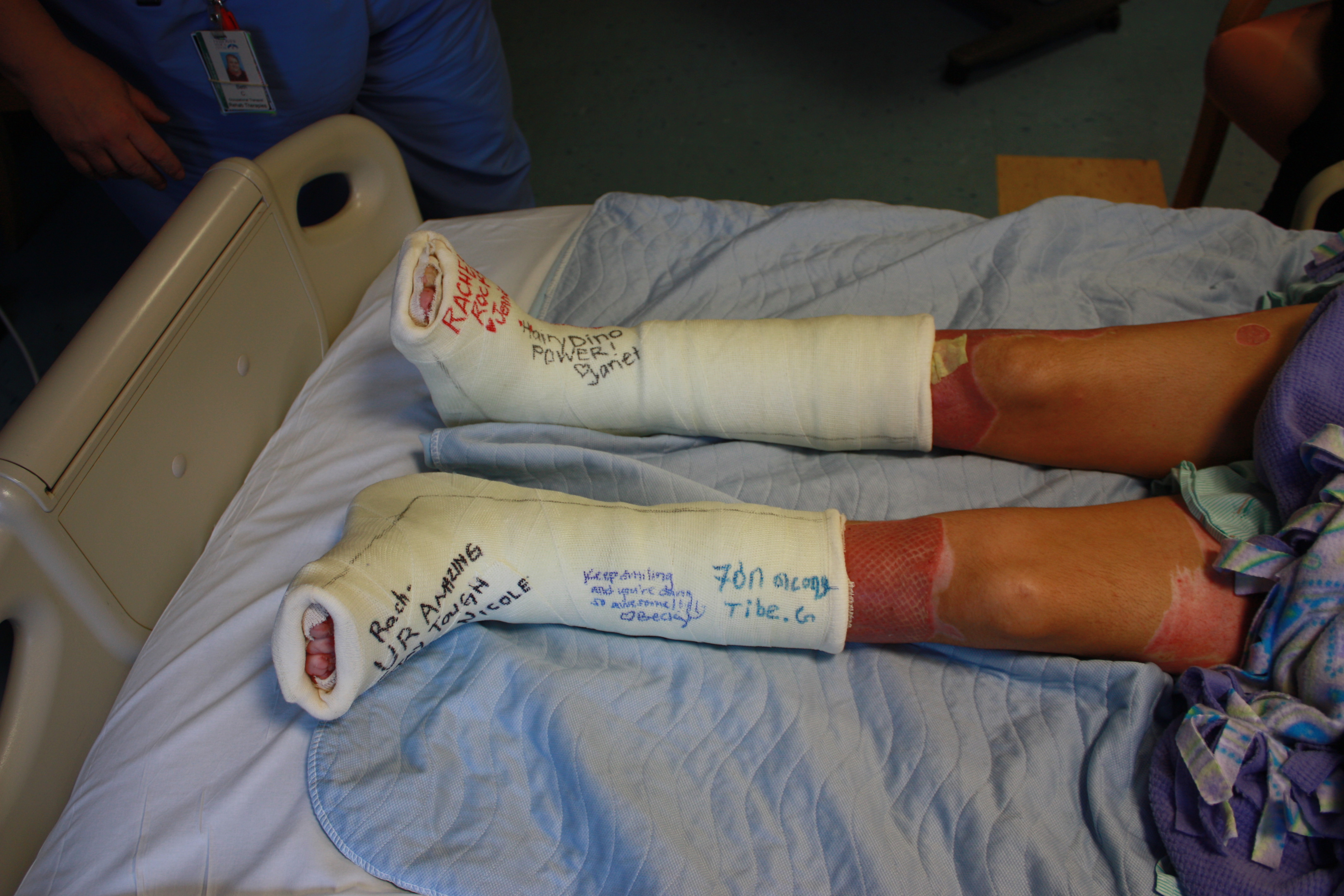 Casts to stretch achilles